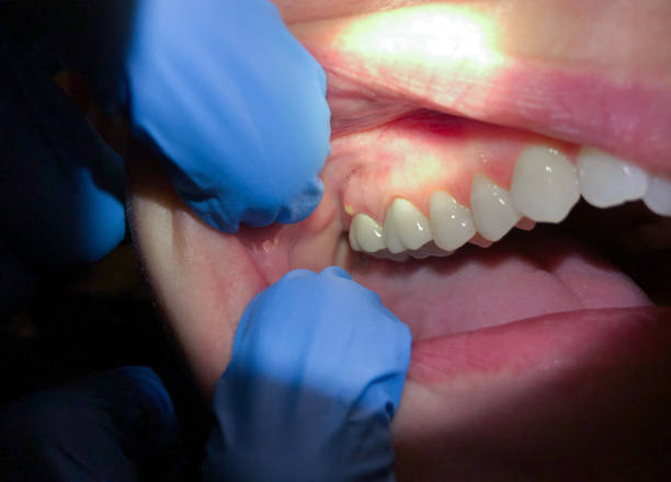 Best Emergency Dental Care for Sports Injuries in Anniston, AL